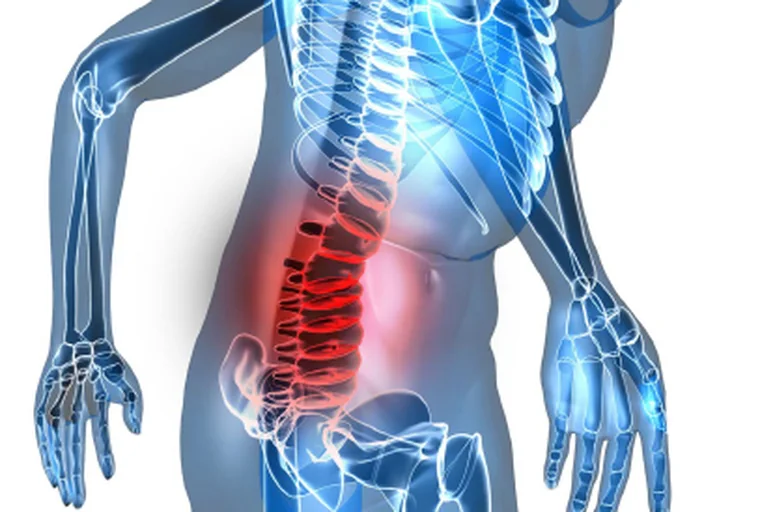 Discopatías: tratamiento con quiropraxia y terapias complementarias en Bogotá