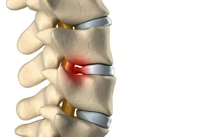 Hernia discal: tratamiento con quiropraxia y terapias complementarias en Bogotá