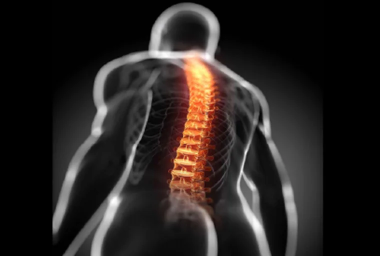 Hipercifosis: tratamiento con quiropraxia y terapias complementarias en Bogotá